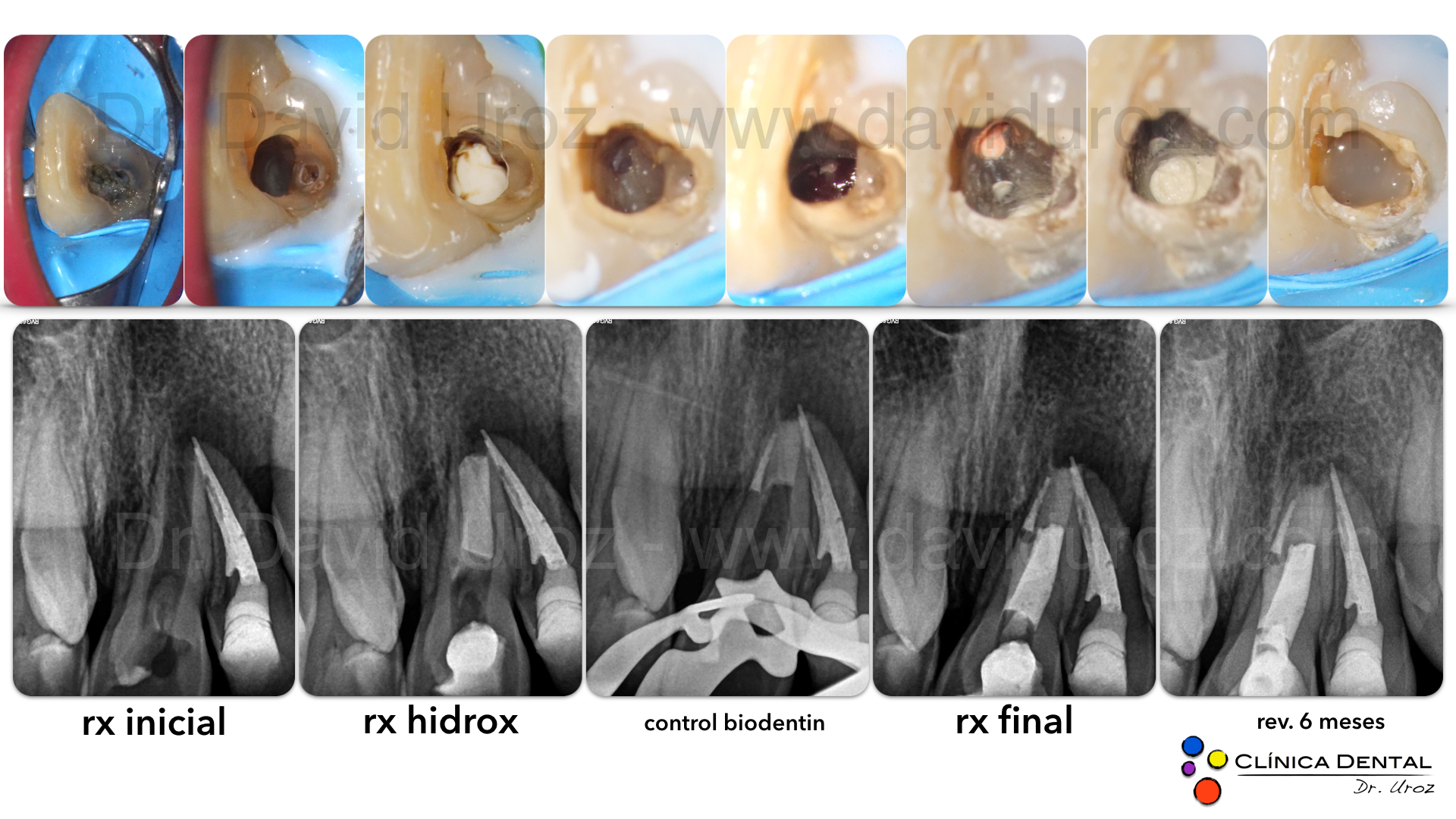 Dens in dente tipo II con ápice inmaduro y raíz secundaria. Combinación interesante!